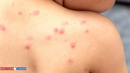 Salud de Cuba informa que han estudiado posibles casos de “viruela del mono”
