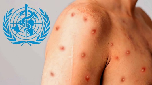 OMS establece fase de emergencia sanitaria mundial por viruela del mono