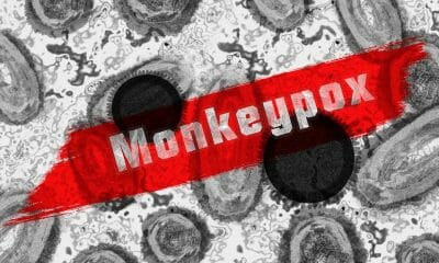 Viruela del mono en Estados Unidos: gobierno declara emergencia de salud pública