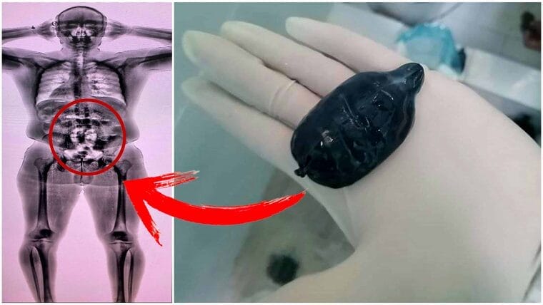 Aduana de Cuba detecta a pasajero con droga en su estómago
