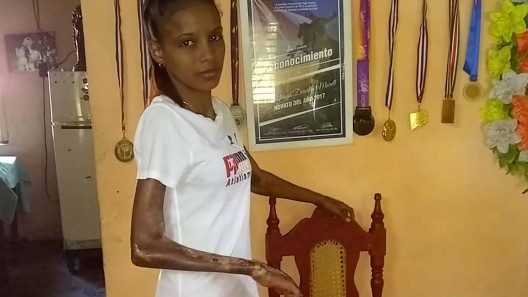 Exdeportista mundialista cubana con enfermedad degenerativa sobrevive con 800 pesos de ayuda
