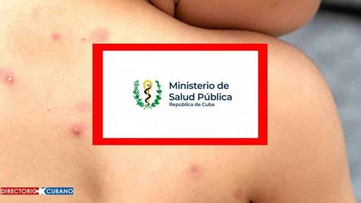 Confirman tercer caso de viruela del mono en Cuba