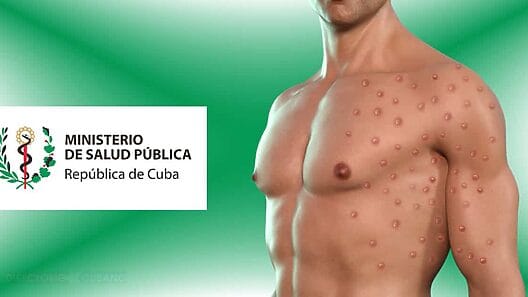 Ocho casos de viruela del mono confirmados en Cuba