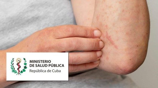 Confirman cuarto caso de viruela del mono en Cuba