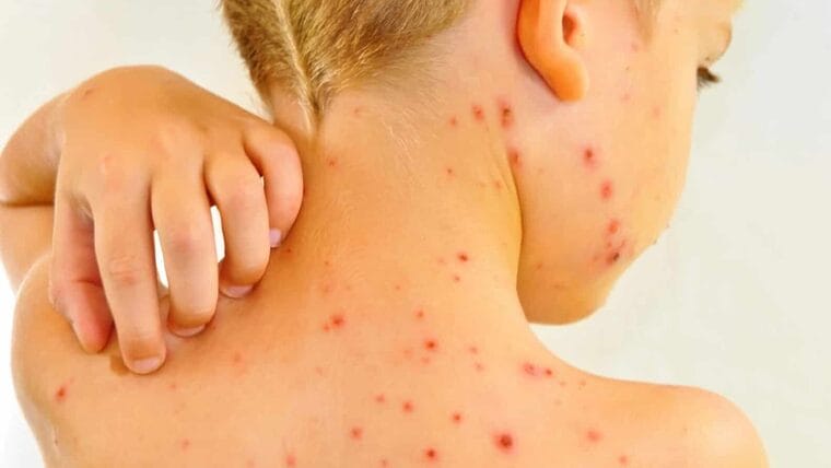 Informan sobre epidemia de varicela en Sancti Spíritus