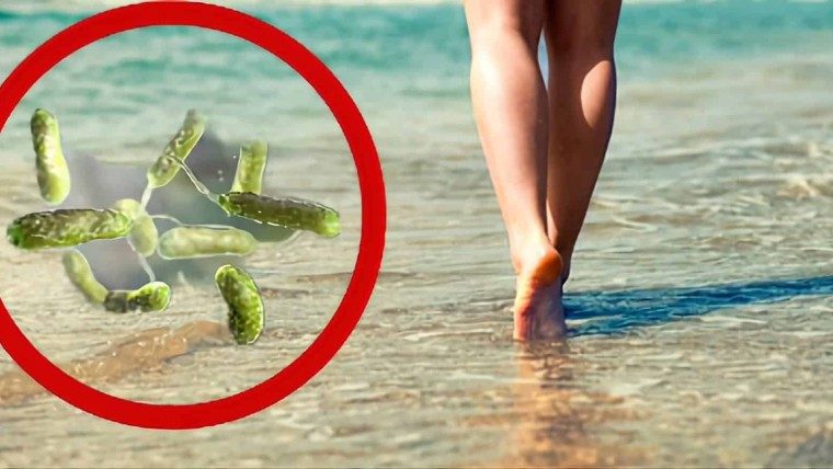 Preocupación ante brote de la bacteria come carne