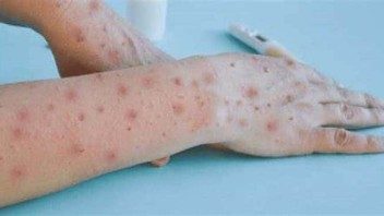 Viruela del Mono: OMS declara emergencia sanitaria internacional