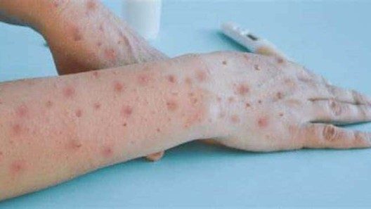 Viruela del Mono: OMS declara emergencia sanitaria internacional