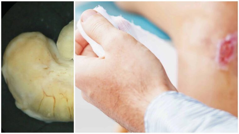 CDC alerta sobre el aumento de casos de la bacteria «carnívora» o «come carne» en Florida