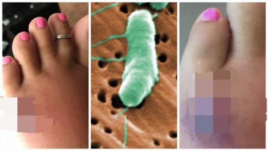 Alerta en playas de Florida: 4 fallecidos por bacterias come carne