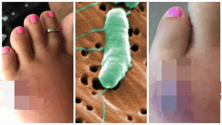 Alerta en playas de Florida: 4 fallecidos por bacterias come carne