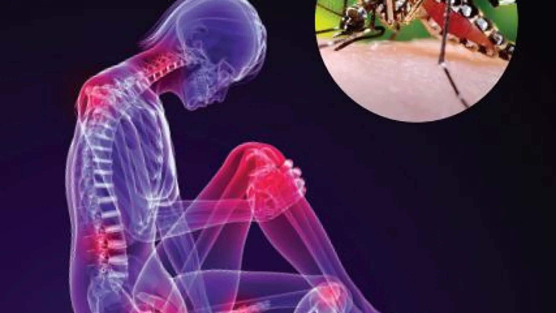 Medicamento para tratar dolores de chikungunya funciona, afirman científicos cubanos