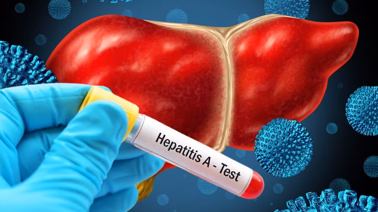 Aumentan los casos sospechosos de hepatitis A en Pinar del Río y San Luis