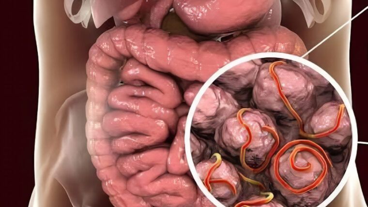 Brote de ciclosporiasis suma 46 casos en Florida: estos son los síntomas