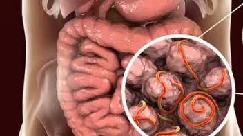 Brote de ciclosporiasis suma 46 casos en Florida: estos son los síntomas