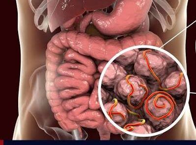 Brote de ciclosporiasis suma 46 casos en Florida: estos son los síntomas